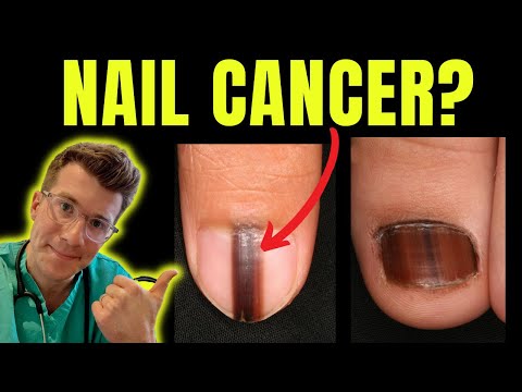 Cancer of the nail? Doctor O'Donovan explains Acral Lentiginous Melanoma and Subungual Melanoma